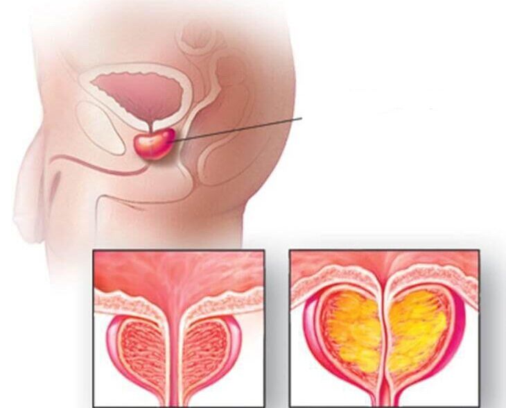 Prostate location, normal prostate and enlarged in chronic prostatitis