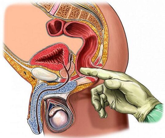Diagnosis of prostatitis