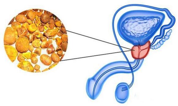 Prostatitis problems