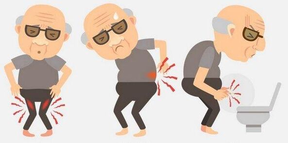 Prostatitis symptoms
