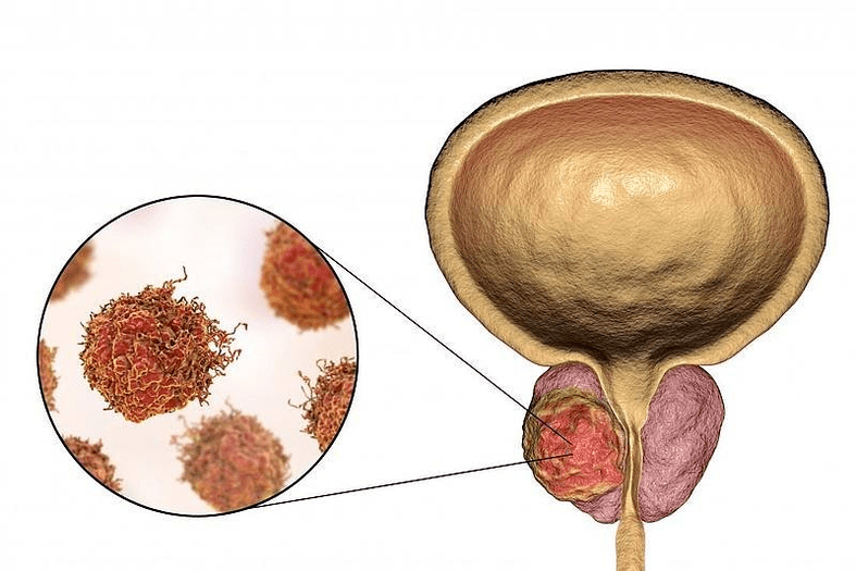 what prostate damage looks like